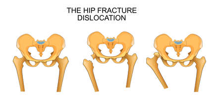 vector illustration of a pelvis, hip fracture. hip dislocationのイラスト素材