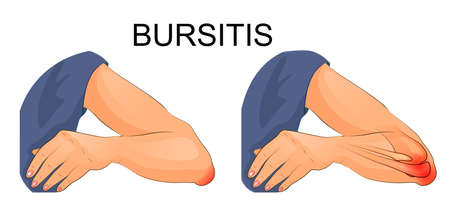 vector illustration of bursitis of the elbow joint.のイラスト素材