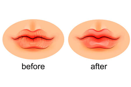 vector illustration of lips dry and after moisteningのイラスト素材