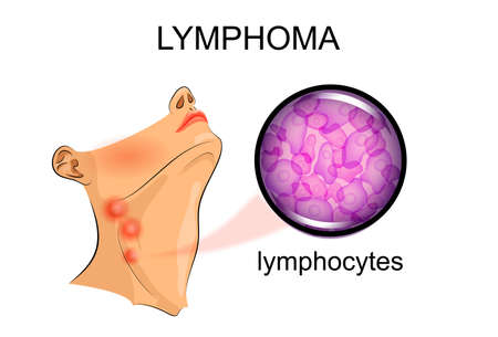 vector illustration of the increase in lymph nodes in lymphoma.のイラスト素材