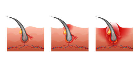 vector illustration of the maturation of acneのイラスト素材
