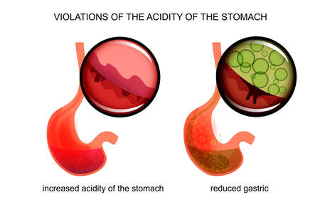 vector illustration of high and low acidity of the stomachのイラスト素材