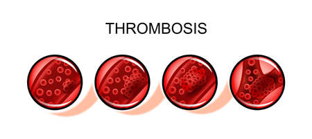 vector illustration of a process of thromboembolismのイラスト素材