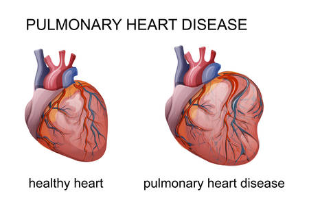 vector illustration of pulmonary heart disease. cardiologyのイラスト素材