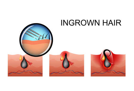vector illustration of ingrown hair, the maturation of the pimpleのイラスト素材