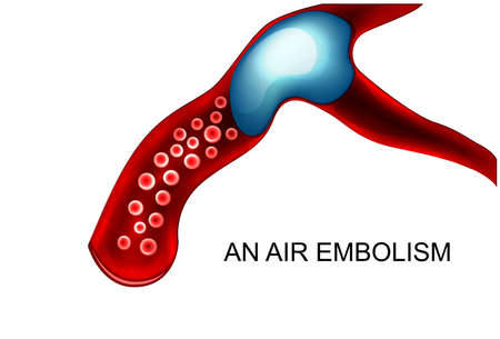 vector illustration of air embolism blood vesselのイラスト素材
