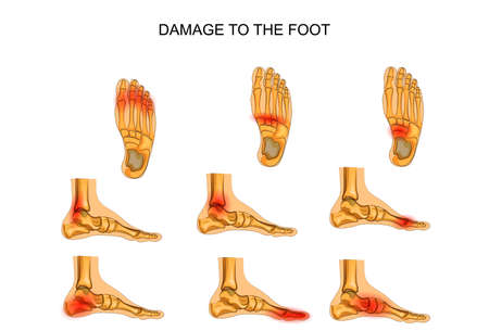 vector illustration of injuries of the footのイラスト素材