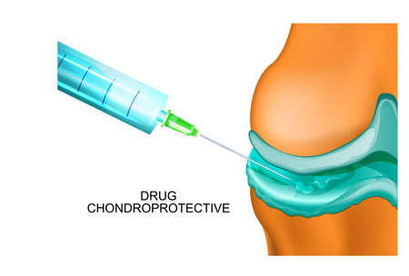 Vector illustration of an injectable treatment of jointsのイラスト素材