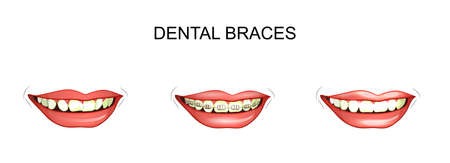 vector illustration of dental braces. dental alignmentのイラスト素材