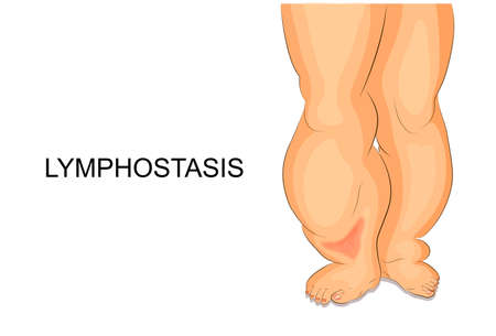 Vector illustration of lymphedema. lymph edema of the feetのイラスト素材