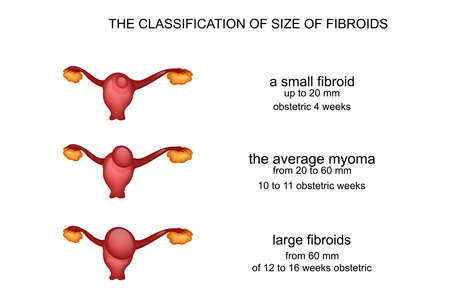 vector illustration of uterine fibroids by week pregnancyのイラスト素材