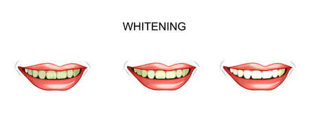 vector illustration of teeth whitening. cleaning plaqueのイラスト素材