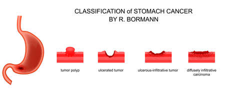 Vector illustration of classification of gastric cancerのイラスト素材