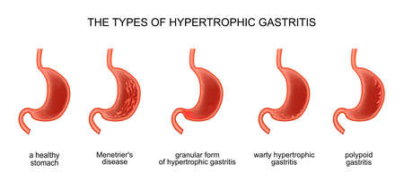 Vector illustration of the types hypertrophic gastritis.のイラスト素材