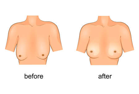 Vector illustration of plastic surgery. Before and afterのイラスト素材