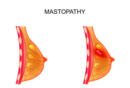 vector illustration of a breast. healthy and diseased mammary glandのイラスト素材