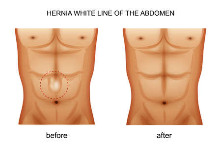 vector illustration of a hernia white line of the abdomenのイラスト素材