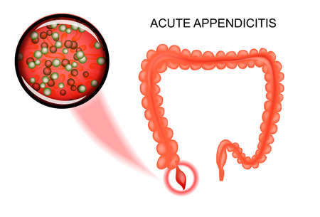 vector illustration of acute appendicitis. the bacteria, inflammationのイラスト素材