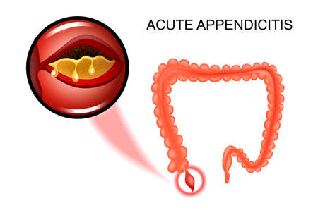 vector illustration of acute appendicitis, the inflammation of the Appendixのイラスト素材