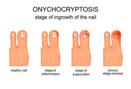 Vector illustration of the stage of ingrown nailのイラスト素材