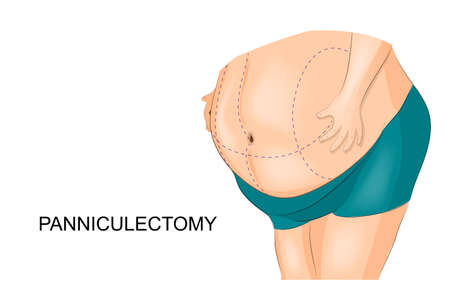 Vector illustration of removal of fat apron. Panniculectomyのイラスト素材