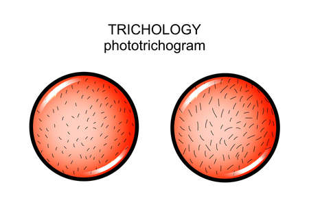 vector illustration of research in trichology. phototrichogram. dermatologyのイラスト素材