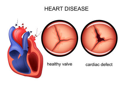 Illustration of a heart defect.のイラスト素材