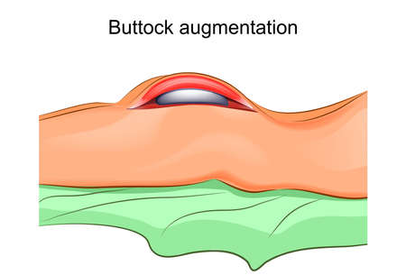 Illustration of a gluteoplasty.のイラスト素材