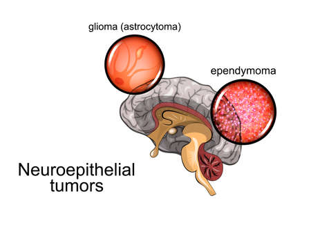 Vector illustration of a brain tumor, neurosurgeryのイラスト素材