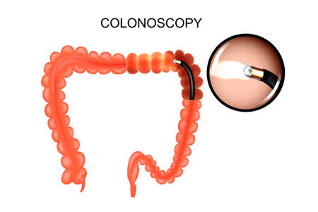 vector illustration of large intestine, colonoscop. medicineのイラスト素材