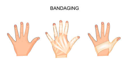 Bandaging of hand vector illustration.のイラスト素材