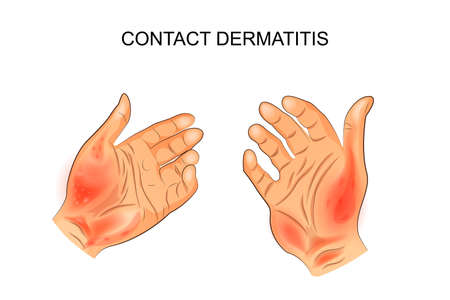 Vector illustration of contact dermatitis.のイラスト素材