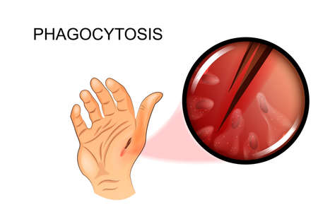 vector illustration of pain in the hand. phagocytosisのイラスト素材