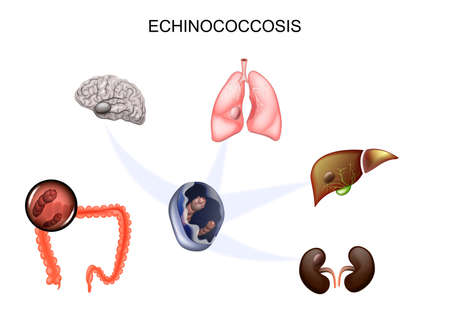vector illustration of hydatid cyst of the brain, liver, lungs and kidneys. the causative agent Echinococcusのイラスト素材