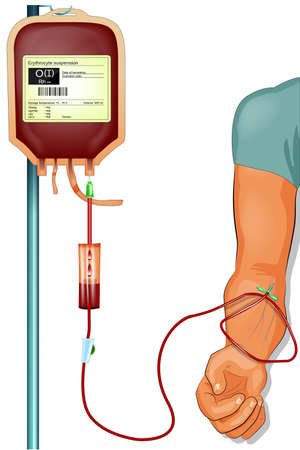 vector illustration of a donor blood transfusion to the patientのイラスト素材