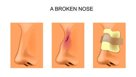 Broken nose with bandageのイラスト素材