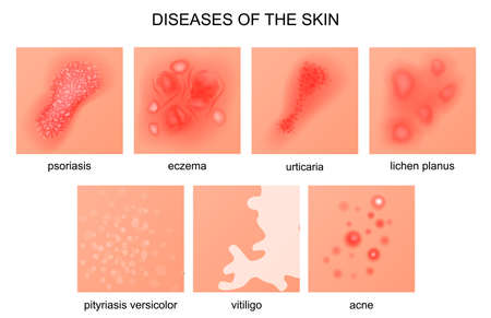 vector illustration of diseases of the skinのイラスト素材