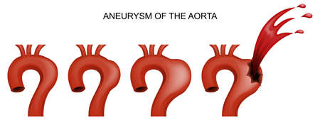 vector illustration of an aortic aneurysm. cardiologyのイラスト素材