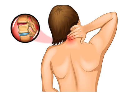 vector illustration of pain in the cervical spineのイラスト素材