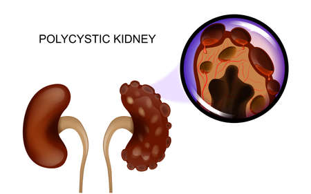 vector illustration of a healthy kidney and a kidney afflicted with polycystic