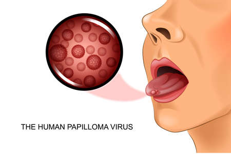 vector illustration of human papillomavirus on tongueのイラスト素材
