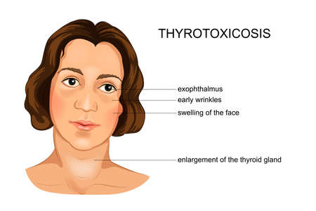 vector illustration of a girl suffering from hypothyroidismのイラスト素材