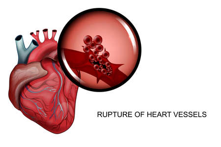 vector illustration of a rupture of the vessels of the heart
のイラスト素材