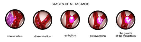 vector illustration of the stage of metastasis of cancer cellsのイラスト素材