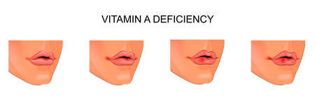 vector illustration of symptoms of vitamin a deficiencyのイラスト素材