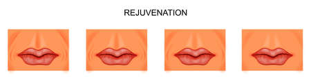 vector illustration of facial rejuvenation, nasolabial foldsのイラスト素材