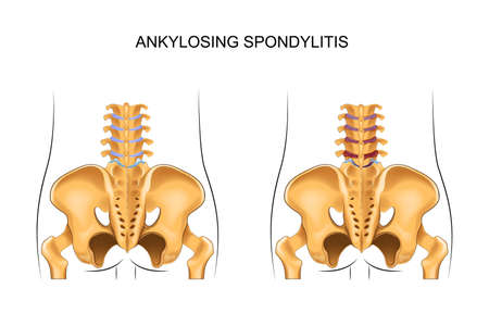 Vector illustration of a healthy lower back and ankylosing spondylitisのイラスト素材