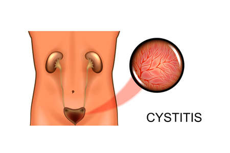 Vector illustration of urinary system. bladder, cystitis.のイラスト素材