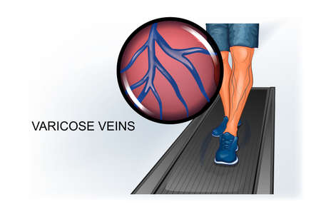 vector illustration of athlete's foot suffering from varicose veinsのイラスト素材