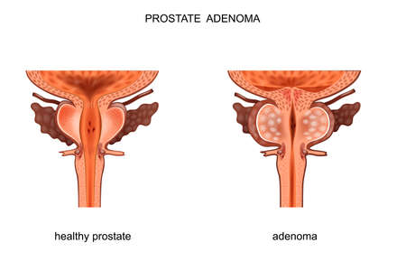 vector illustration of a healthy prostate and BPHのイラスト素材